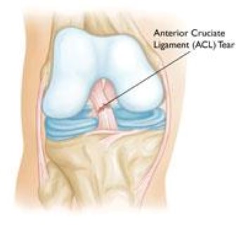 Knee Injury Claims